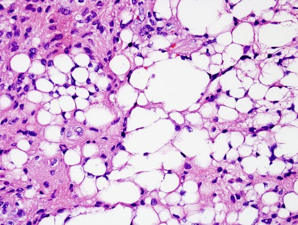 1A9 Liponeurocytoma, cerebellar (Case 1) H&E 38.jpg