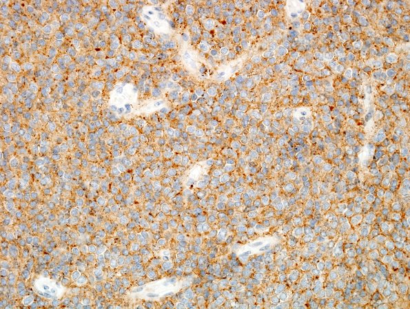 1B1 Liponeurocytoma, cerebellar (Case 1) SYN 4.jpg