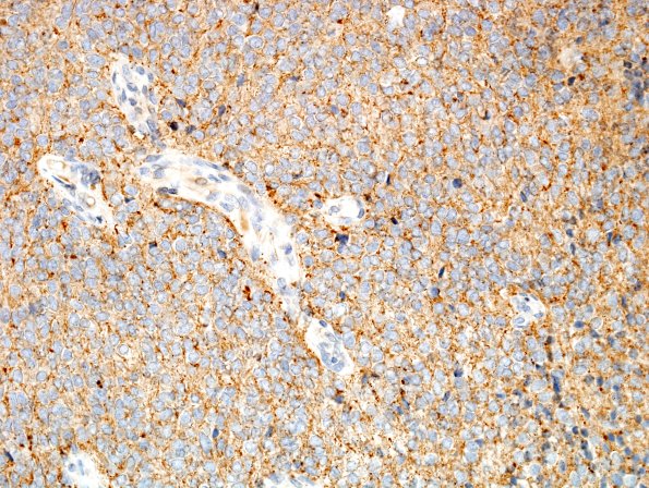 1B2 Liponeurocytoma, cerebellar (Case 1) SYN 2.jpg