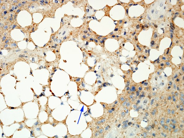 1B3 Liponeurocytoma, cerebellar (Case 1) SYN 6 copy.jpg