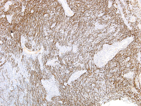 1C1 Liponeurocytoma, cerebellar (Case 1) NF 7.jpg