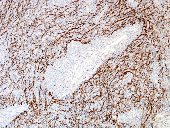 1C2 Liponeurocytoma, cerebellar (Case 1) NF 4.jpg