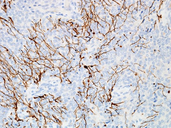 1C3 Liponeurocytoma, cerebellar (Case 1) NF 1