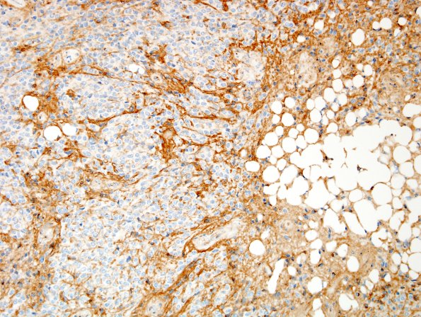 1D Liponeurocytoma, cerebellar (Case 1) CD99 2.jpg