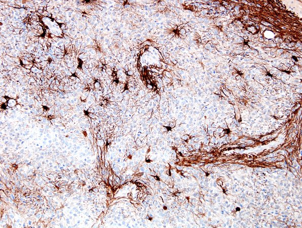 1E1 Liponeurocytoma, cerebellar (Case 1) GFAP 8.jpg