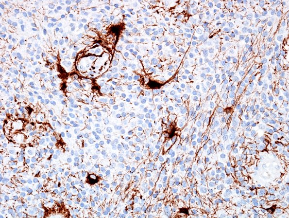 1E2 Liponeurocytoma, cerebellar (Case 1) GFAP 5.jpg