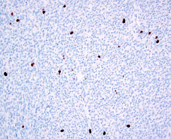 1F Liponeurocytoma, cerebellar (Case 1) MIB1 1.jpg