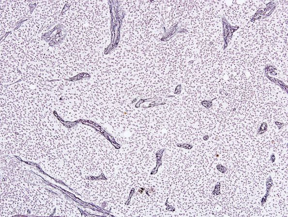 1G Liponeurocytoma, cerebellar (Case 1) Retic 4.jpg