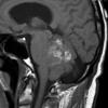 2A1 Liponeurocytoma, cerebellum (Case 2) T1 - Copy