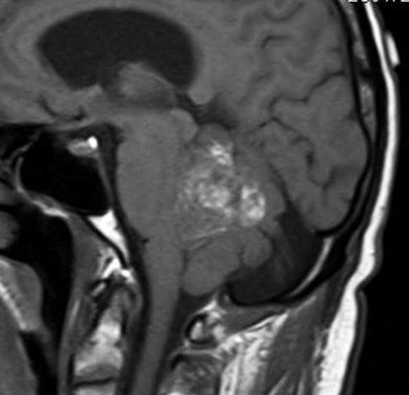 2A1 Liponeurocytoma, cerebellum (Case 2) T1 - Copy