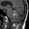 2A2 Liponeurocytoma, cerebellum (Case 2) T1 - Copy