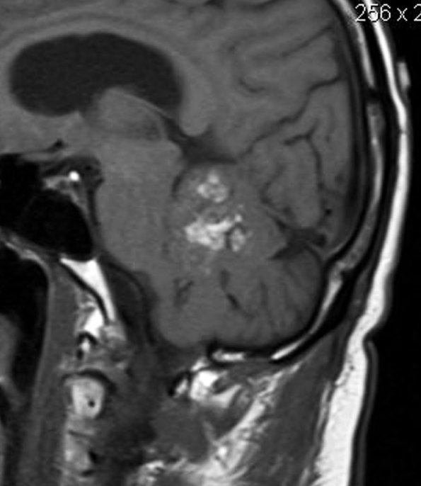 2A2 Liponeurocytoma, cerebellum (Case 2) T1 - Copy