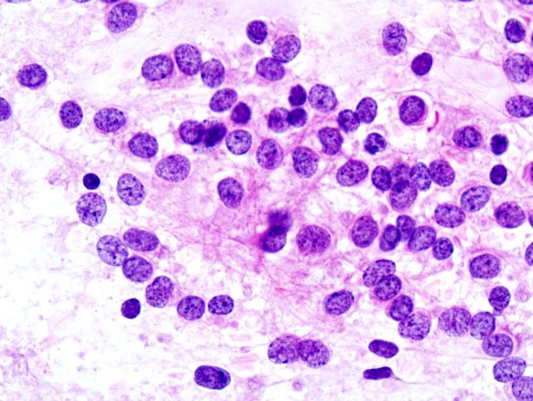 2B1 Liponeurocytoma, cerebellum (Case 2) Smear 1.jpg