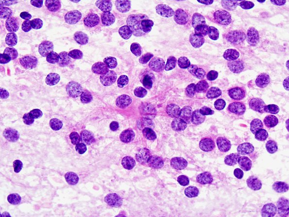 2B2 Liponeurocytoma, cerebellum (Case 2) Smear 2.jpg