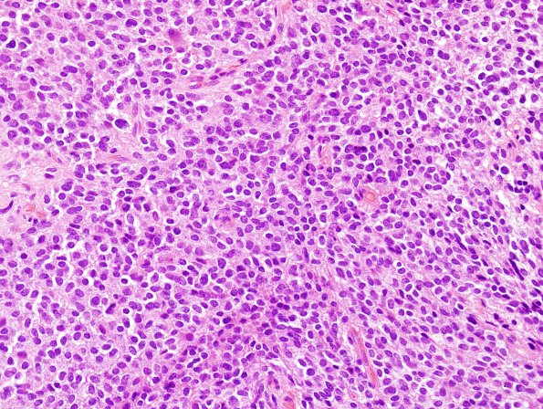 2B3 Liponeurocytoma, cerebellar (Case 2) H&E 4.jpg