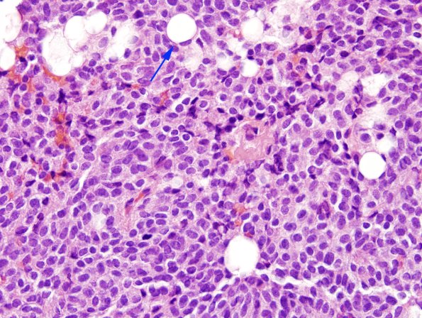 2B4 Liponeurocytoma, cerebellar (Case 2) H&E 7 copy.jpg