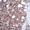 2C1 Liponeurocytoma, cerebellum (Case 2) SYN 1.jpg