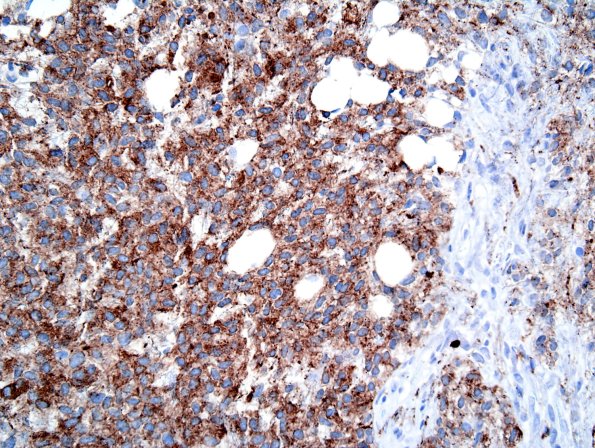 2C1 Liponeurocytoma, cerebellum (Case 2) SYN 1.jpg