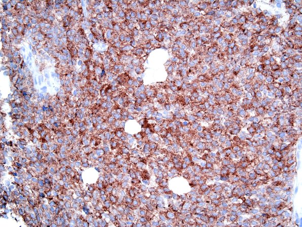 2C2 Liponeurocytoma, cerebellum (Case 2) SYN 2.jpg