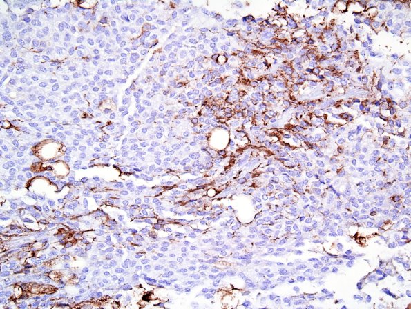 2D Liponeurocytoma, cerebellum (Case 2) GFAP 1.jpg