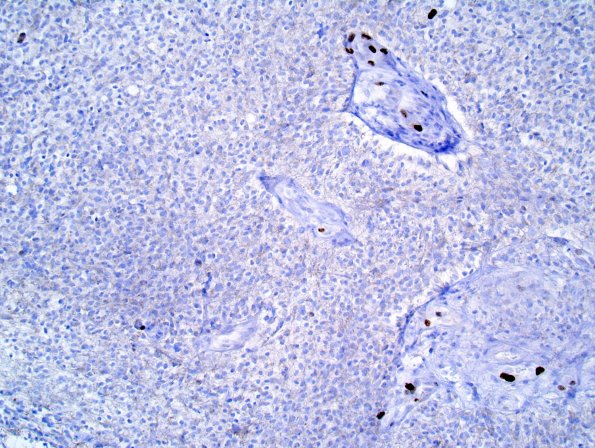 2E Liponeurocytoma, cerebellum (Case 2) Ki-67 1.jpg