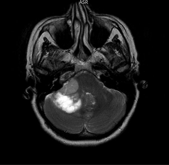 3A1 Liponeurocytoma, cerebellum (Case 3) T1W 1 - Copy