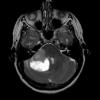 3A2 Liponeurocytoma, cerebellum (Case 3) T1W 2 - Copy