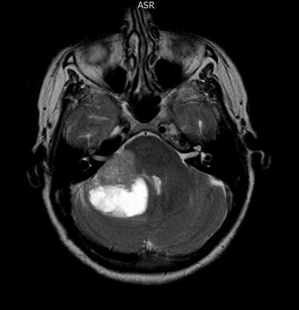 3A2 Liponeurocytoma, cerebellum (Case 3) T1W 2 - Copy