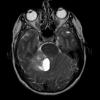 3A3 Liponeurocytoma, cerebellum (Case 3) T2W - Copy