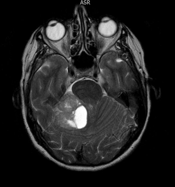 3A3 Liponeurocytoma, cerebellum (Case 3) T2W - Copy