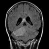 3A4 Liponeurocytoma, cerebellum (Case 3) FLAIR - Copy