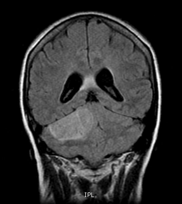 3A4 Liponeurocytoma, cerebellum (Case 3) FLAIR - Copy