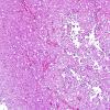 3B1 Liponeurocytoma, cerebellar (Case 3) H&E 11.jpg