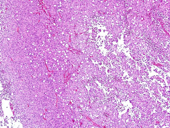 3B1 Liponeurocytoma, cerebellar (Case 3) H&E 11.jpg