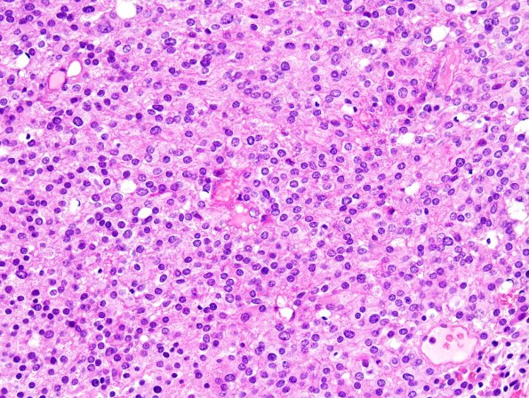 3B2 Liponeurocytoma, cerebellum (Case 3) 61.jpg