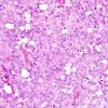 3B3 Liponeurocytoma, cerebellar (Case 3) H&E 6.jpg