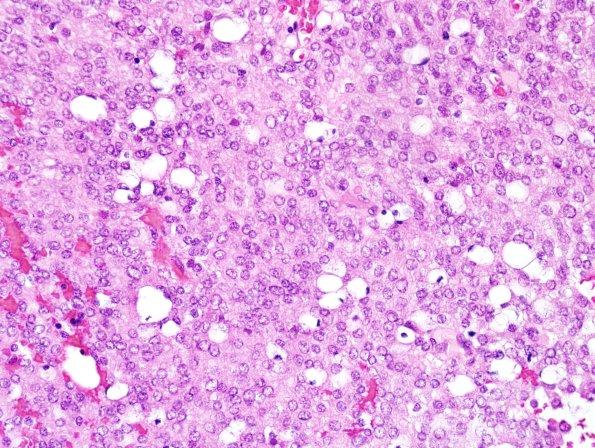 3B3 Liponeurocytoma, cerebellar (Case 3) H&E 6.jpg