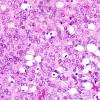 3B4 Liponeurocytoma, cerebellar (Case 3) H&E 7.jpg