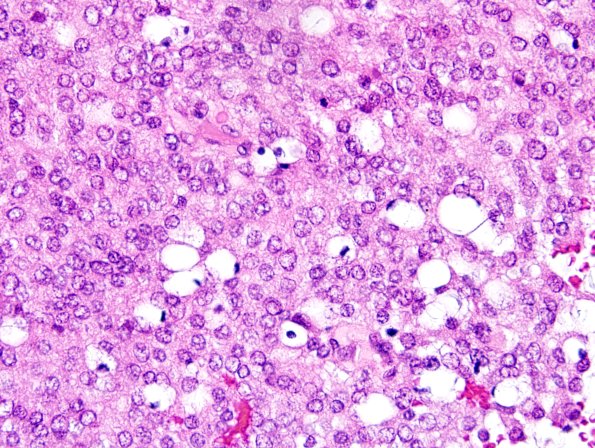 3B4 Liponeurocytoma, cerebellar (Case 3) H&E 7.jpg