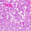 3B5 Liponeurocytoma, cerebellum (Case 3) 3.jpg