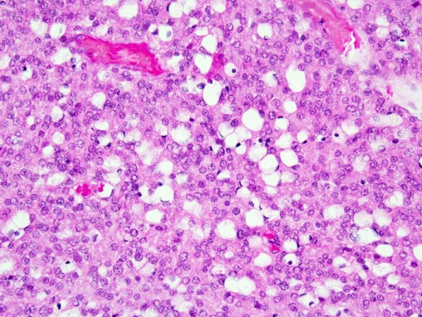 3B5 Liponeurocytoma, cerebellum (Case 3) 3.jpg