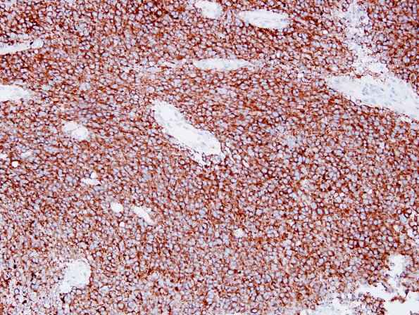 3C Liponeurocytoma, cerebellar (Case 3) SYN.jpg