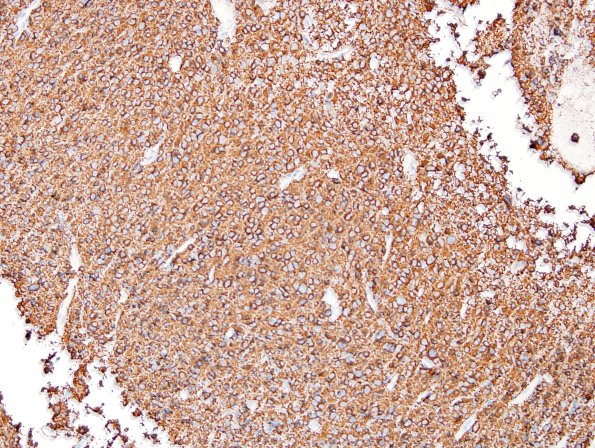 3D1 Liponeurocytoma, cerebellar (Case 3) Chromogranin.jpg