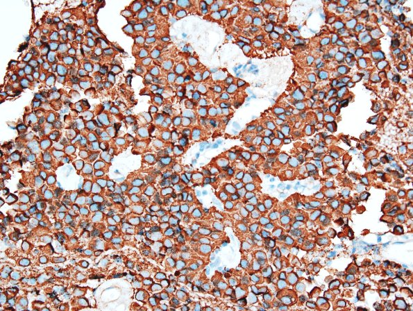 3D2 Liponeurocytoma, cerebellum (Case 3) Chrom 2.jpg