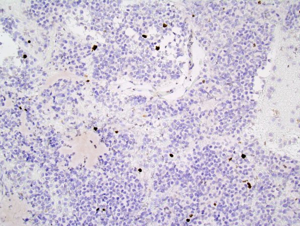 3F Liponeurocytoma, cerebellum (Case 3) Ki-67 2.jpg