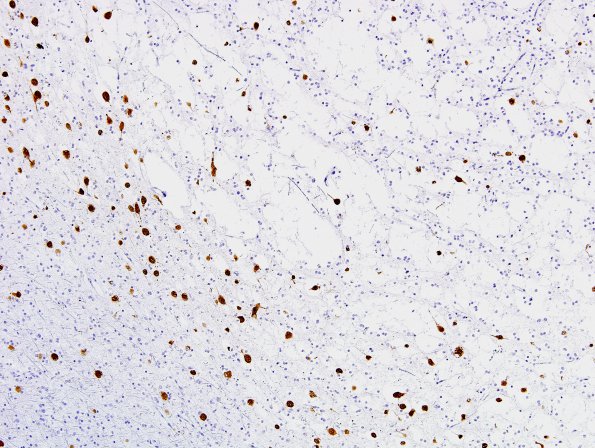 10B DNET (Case 10) NeuN 5.jpg