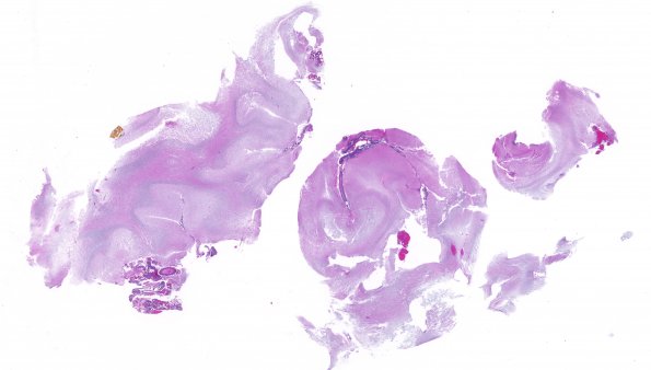 13A1 DNET, cerebellum (Case 13) H&E whole mount