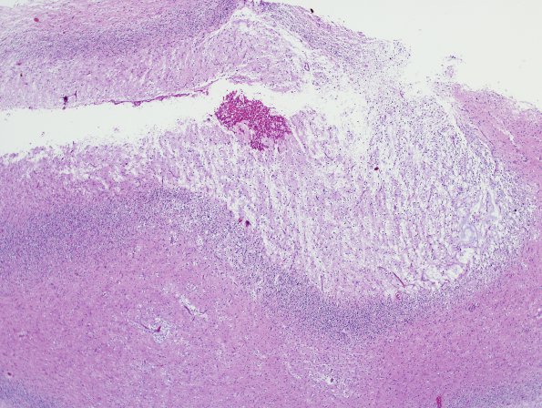 13A2 DNET, cerebellum (Case 13) H&E 1