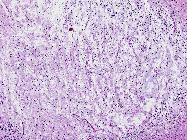 13A3 DNET, cerebellum (Case 13) H&E 2