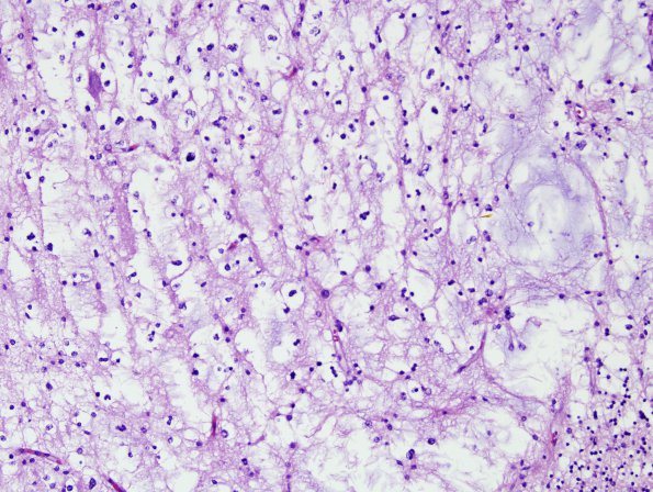 13A4 DNET, cerebellum (Case 13) H&E 3